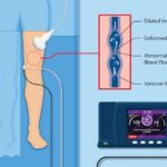 Varicose Veins