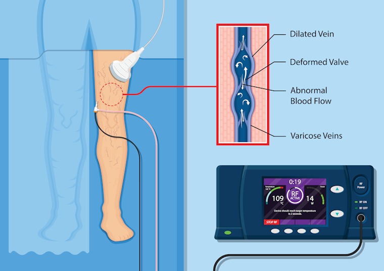 Varicose Veins