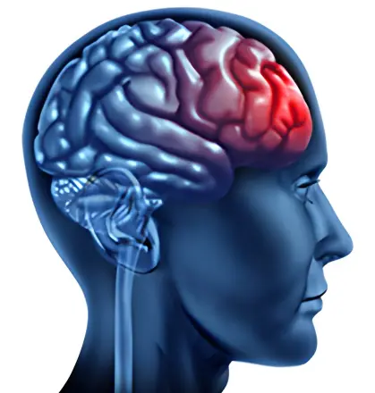 Intracranial Stenosis