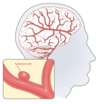 brain aneurysm
