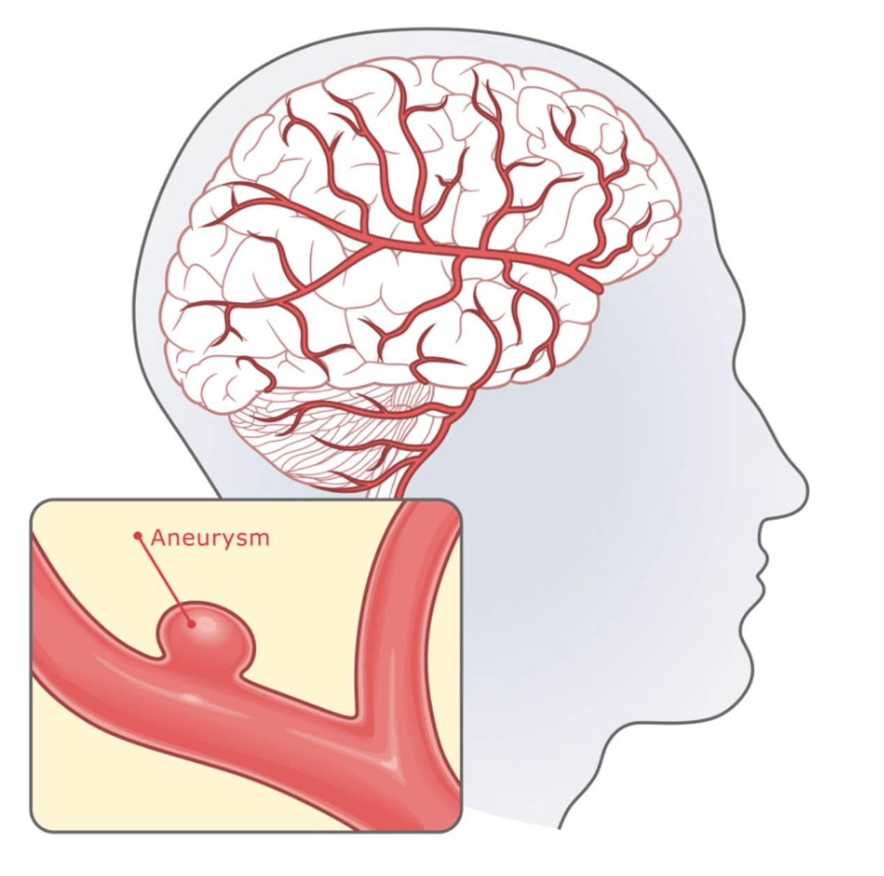 brain aneurysm