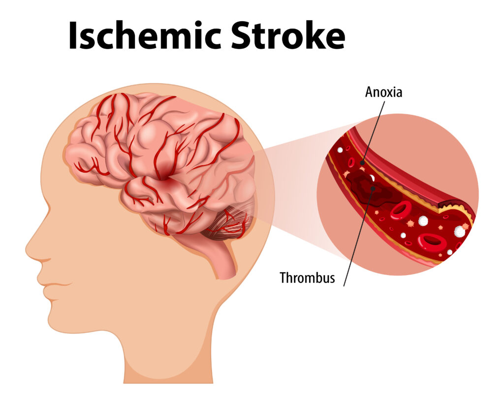 Ischemic Stroke: Symptoms, Treatment and Recovery Guide