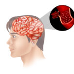 Ruptured Brain Aneurysm: Symptoms causes and Treatment