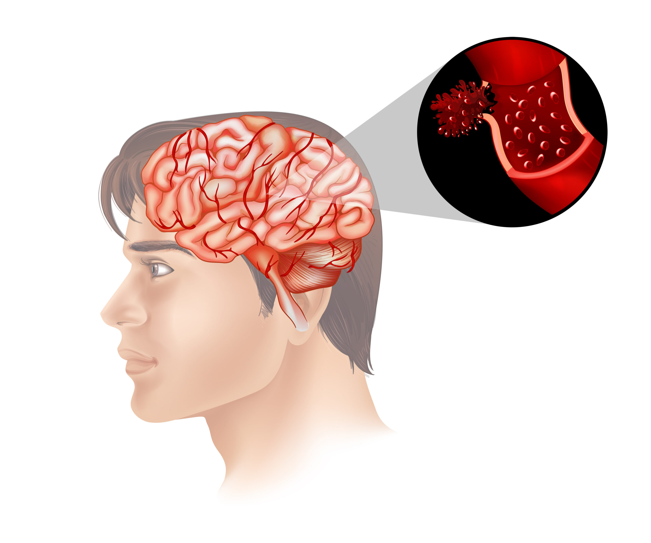 Ruptured Brain Aneurysm: Symptoms Causes And Treatment