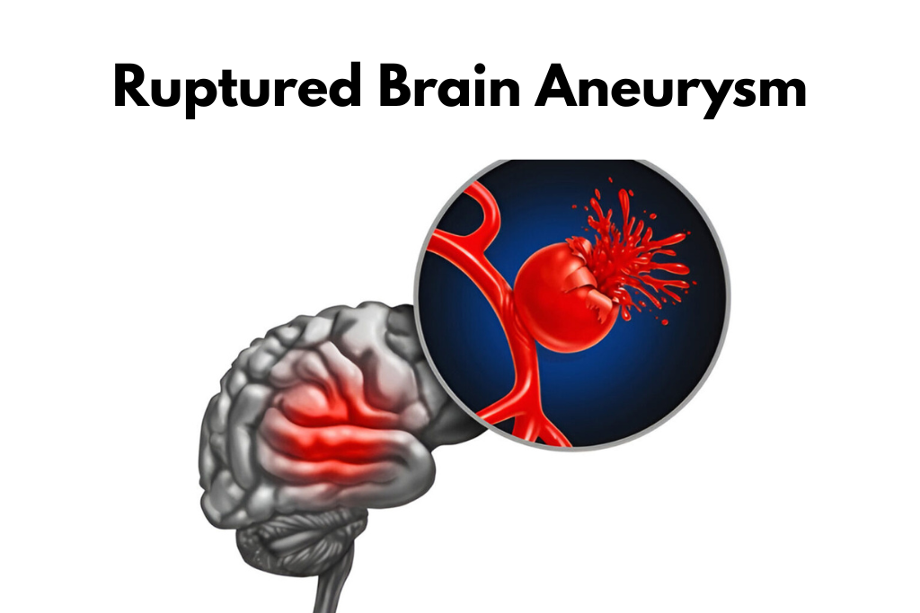 Ruptured Brain Aneurysm: Symptoms causes  and  Treatment.