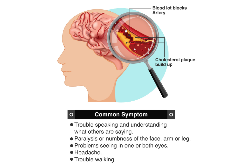 Ischemic Stroke: Symptoms, Treatment and Recovery Guide
