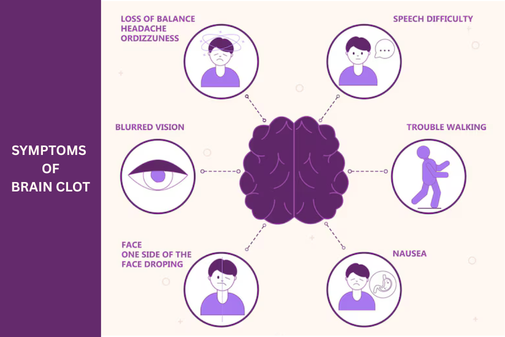 Brain Clot Symptoms: Early Warning Signs to Never Ignore