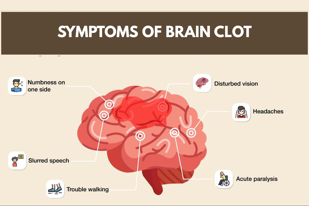 Trusted Interventional Neuroradiologist for Brain Clots 