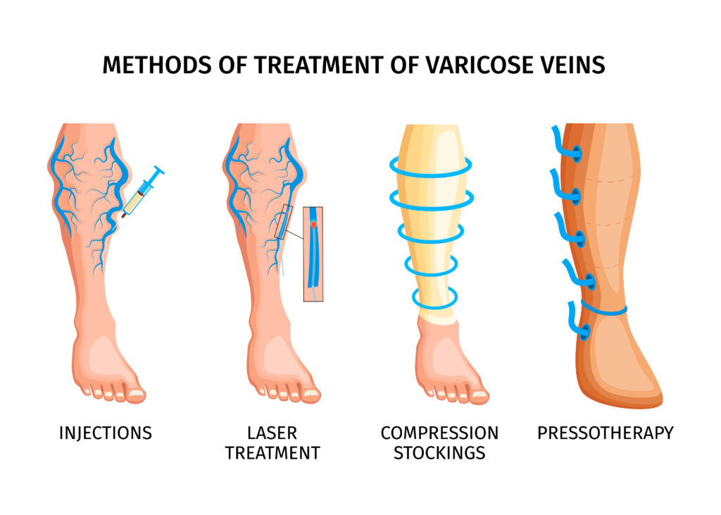 When to Worry About Varicose Veins | Signs, Symptoms & Care