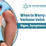 When to Worry About Varicose Veins | Signs, Symptoms & Care
