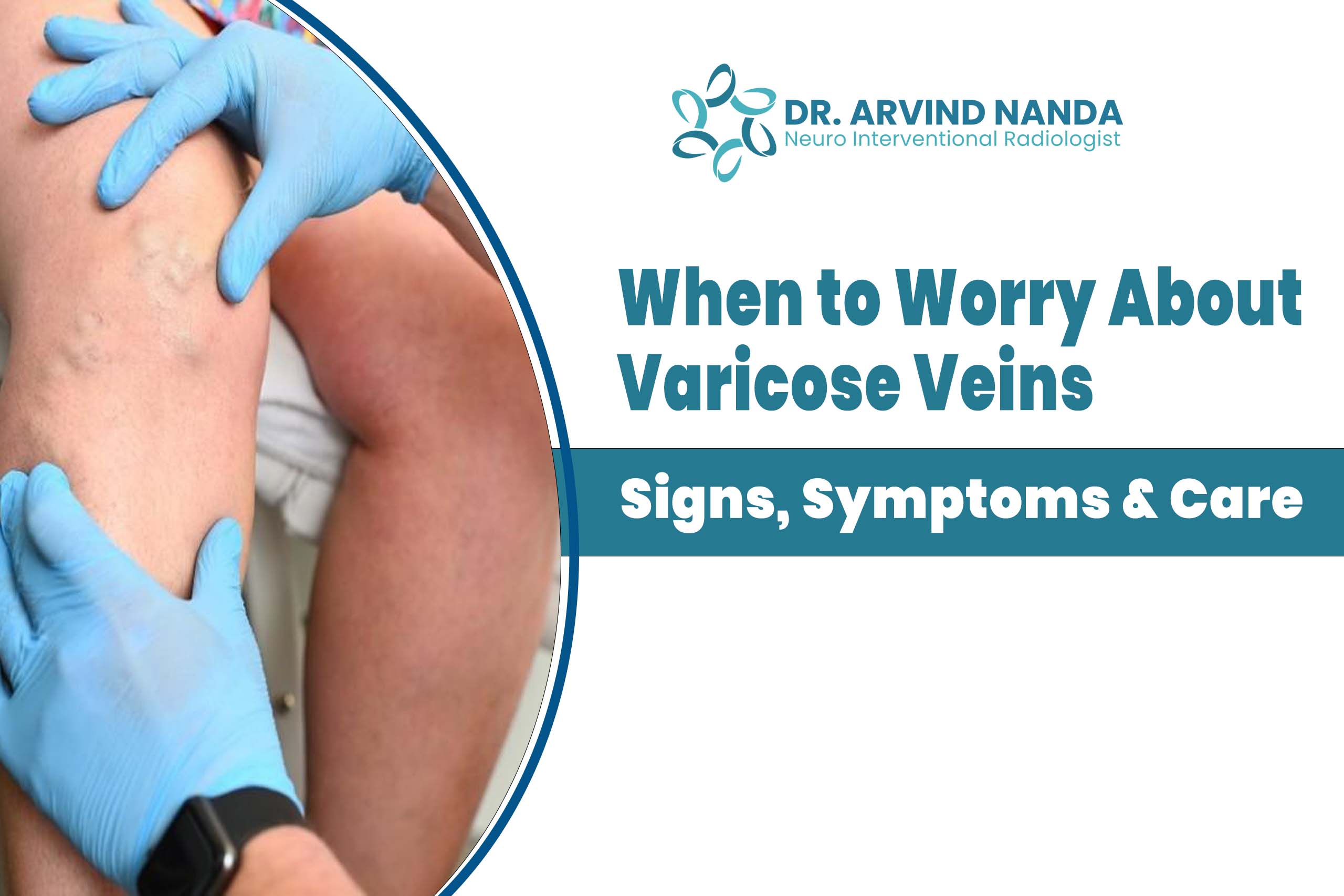 When to Worry About Varicose Veins | Signs, Symptoms & Care