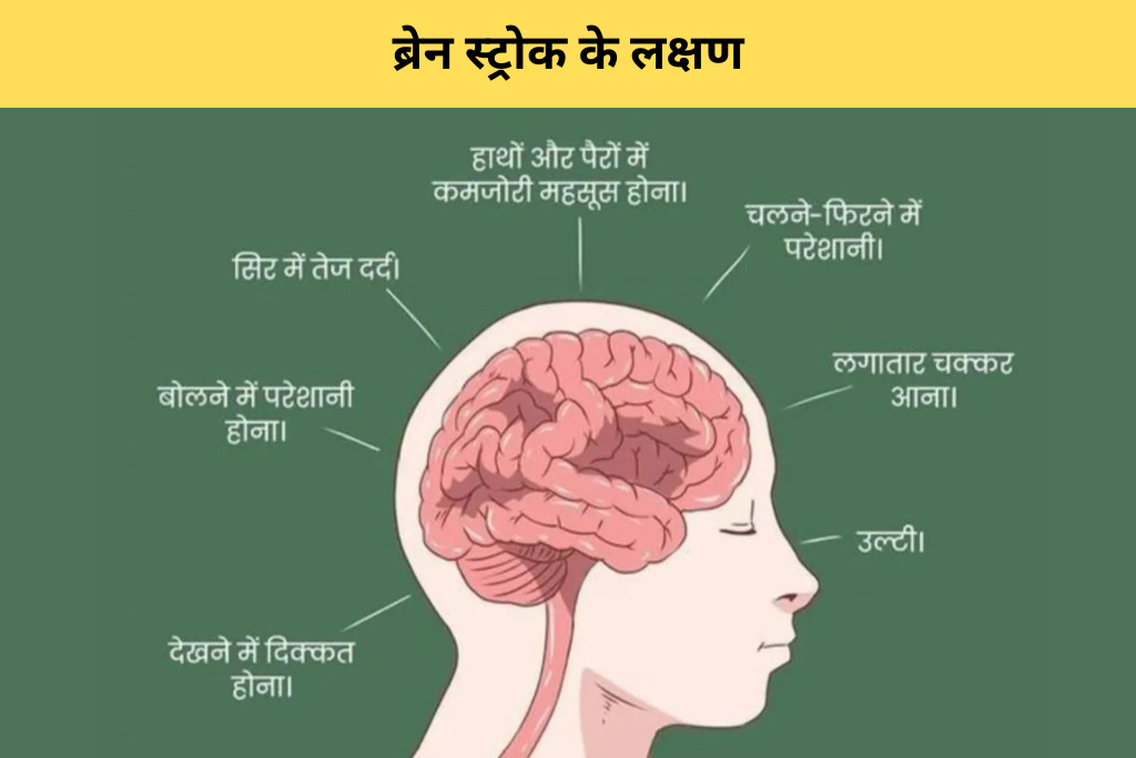 ब्रेन स्ट्रोक क्यों होता है | लक्षण, कारण और बचने के उपाय